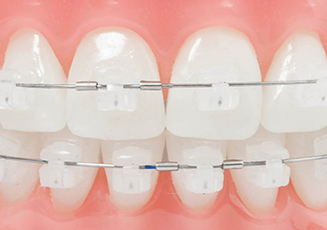 About Smiles Dental Centres - Broken or Lost Dental