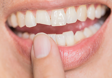 About Smiles Dental Centres - Fractured Teeth