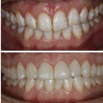 About Smiles Dental Centres - Case #1