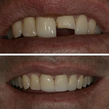 About Smiles Dental Centres - Case #10