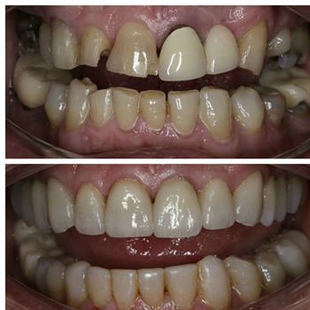 About Smiles Dental Centres - Case #5