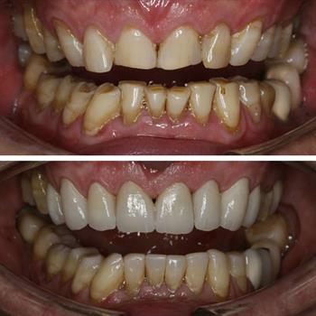 Case for Teeth Whitening and Implant