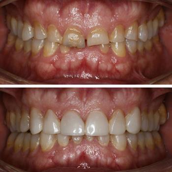 About Smiles Dental Centres - Case #8