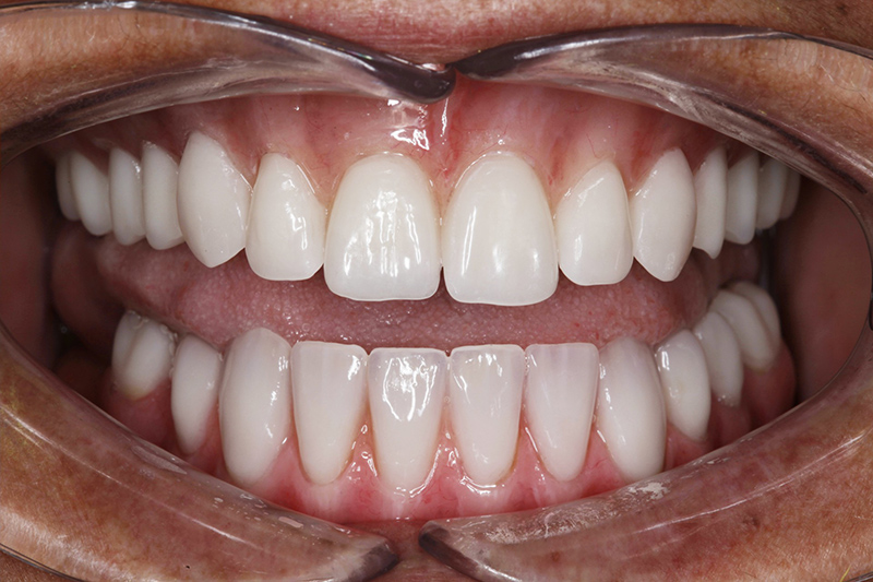 About Smiles Dental Centres - Denture