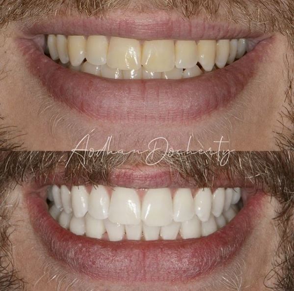 Teeth Whitening at About Smiles Dental