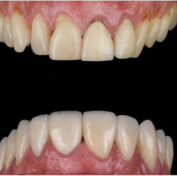 About Smiles Dental Centres - Veneers